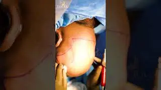 Hair Transplant in Chennai | Amazing Hair Transplant Results | Tamira Plastic Surgery 