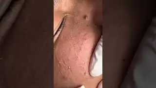 How to care for a rough face
