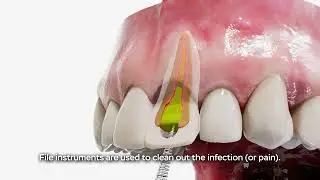 Anterior Root Canal and Crown
