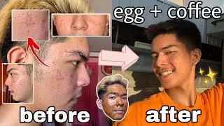 I TRIED THE EGG + COFFEE FACE MASK | BEST FACE MASK PAMPATANGGAL PIMPLES AT ACNE SCARS?!