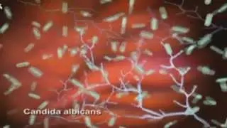 Mycose Vaginale -- Définition Et Causes