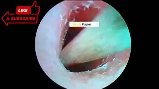 Ear Wax Removal 2022 Big Ear Wax Removing of Girl