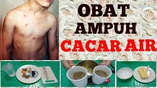 Obat Cacar air yang ampuh | kulit mulus kinclong tanpa bekas