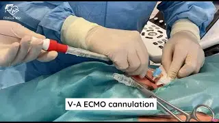 ECMO cannulation
