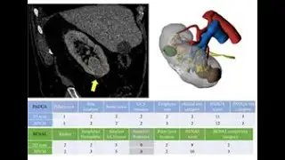 3D virtual imaging of renal tumours: a new tool to improve the accuracy of nephrometry scores