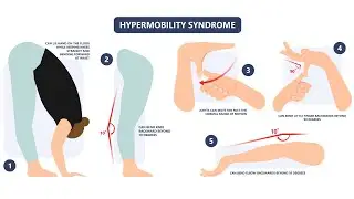 Joint Hypermobility Syndrome ; Definition, Symptoms, Causes, Diagnosis, Treatment