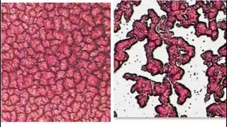 Looking at Free Radical Damage and Toxicity in Dry Blood Analysis - Live Blood Analysis Training