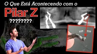 Implante Zigomático Duplo com Pilar Z - Uma Tragédia Anunciada? - Técnica Faco Implante