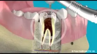 Root canal Treatment Marathi