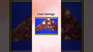 Side effects of Tetracycline