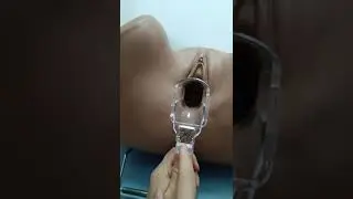 How to use speculum