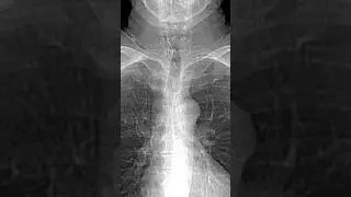 What is s Coronary Artery Calcium Scan?