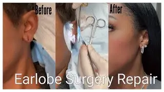 Stretched Earlobe Repair vlog: Do I recommend? Pain? Getting ears pierced again #surgery #ears