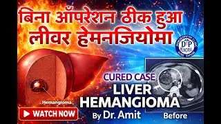 LIVER HEMANGIOMA Cured case (HEMANGIOMA LIVER is curable without surgery under homoeopathy)