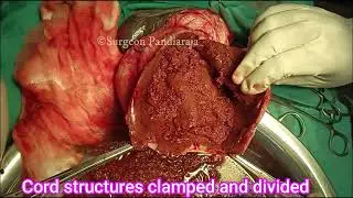 Pyocele| orchidectomy| Dr. Pandiaraja