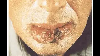 Squamous Cell Carcinoma