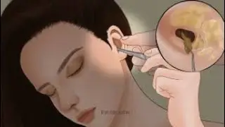 ASMR ANIMATION EAR CLEANING /Earwax remover