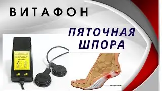 Витафон. Лечение пяточной шпоры.