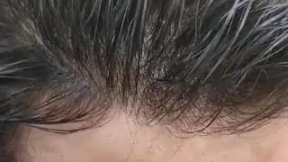 الشبكية الفرنسية علاج الصلع الوراثي والشعر الخفيف في ساعة زمن واحدة 01150543471