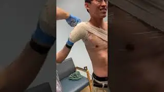 Transhumeral Prosthesis Casting Process