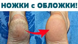 ИДЕАЛЬНЫЕ ПЯТКИ КАК У МЛАДЕНЦА Волшебное средство В ЛЮБОЙ АПТЕКЕ! СТОП - Натоптыши Мозоли Трещины