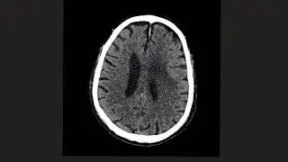 Intra-axial vs Extra-axial brain lesions: Can you tell the difference?