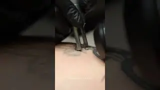 Удаление тату лазером на бедре. Процесс удаления татуировки неодимовым лазером. Приходи, удаляй!