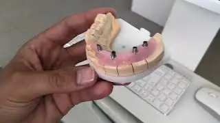 Aoralscan - tipy a triky - Skenování implantátů