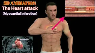 myocardial infarction physiology #myocardialinfarction #heartattack #3danimation #disease#physiology