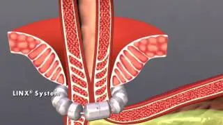 LINX Procedure - Texas Laparoscopic Consultants