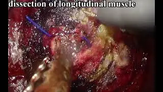 Total anterior pelvic exenteration with clarification of transanal anatomic landmarks