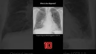 Chest X-ray Quiz 12 (explanation with overlays)