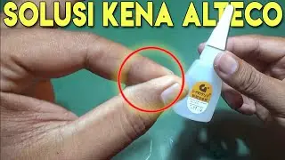 Cara Melepaskan Kulit Jari Kena ALTECO Lem G Super Glue