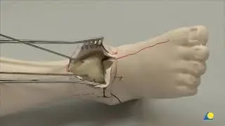 Ankle Arthrodesis - Anterior Approach