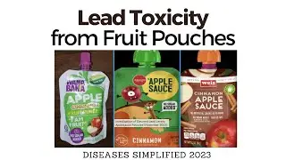 Dangerous Lead Toxicity from Toddler Fruit Pouches