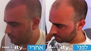 נקודות בשיער -נקודות בראש נקודות בקרקפת הדמיית שיער במפרצים