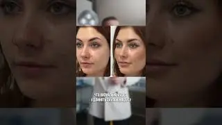 Носогубная складка, как корректировать?