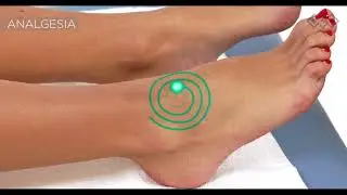 BTL 6000 High Intensity Laser Ankle Distortion