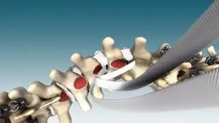 Universal Spinal Clamp Fixation System