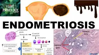 ENDOMETRIOSIS: Etiopathogenesis, Cinical features and Pathology