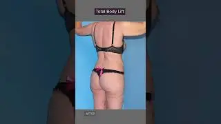 Total Body Lift ⌛️