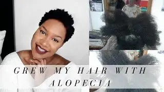 How to grow your hair back  | Alopecia Areata | K A N I