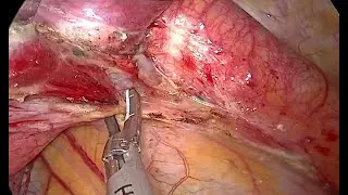 Uniportal Video-Assisted Thoracic Surgery Left Lower Posterobasal Anatomic Segmentectomy S10