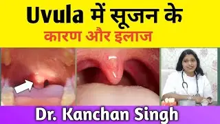 uvula में सूजन का इलाज / swelling of uvula / काग लटकना / Dr. Kanchan Singh