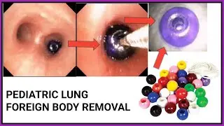 Pediatric Lung Foreign Body Removal Of Bead ! শিশুর ফুসফুস থেকে পুঁতি দানা বের করা হলো #BD_ENDOSCOPY