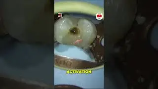 Unlocking Dental Secrets  Ultrasonic Activation for GP