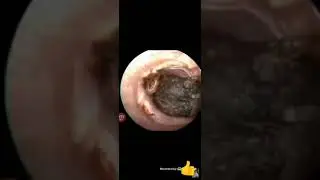 Ушные болезни. Серная пробка,инородное тело в ушном проходе