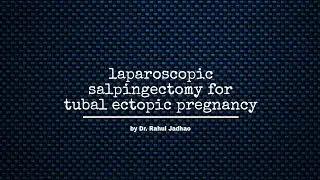 Laparoscopic salpingectomy for  tubal ectopic pregnancy