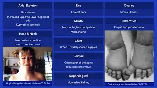 Turner Syndrome: Dysmorphic Features