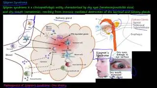 101P - What is Sjögren Syndrome?